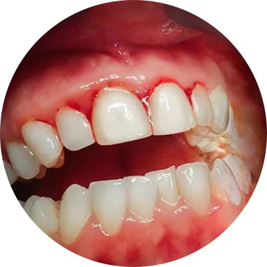 Periodontitis - FlipCard